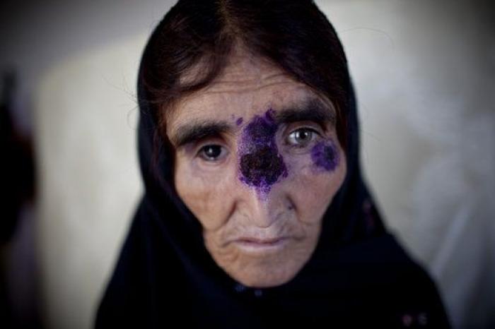 Leishmaniasis, la enfermedad que se está cebando con los refugiados de Oriente Medio