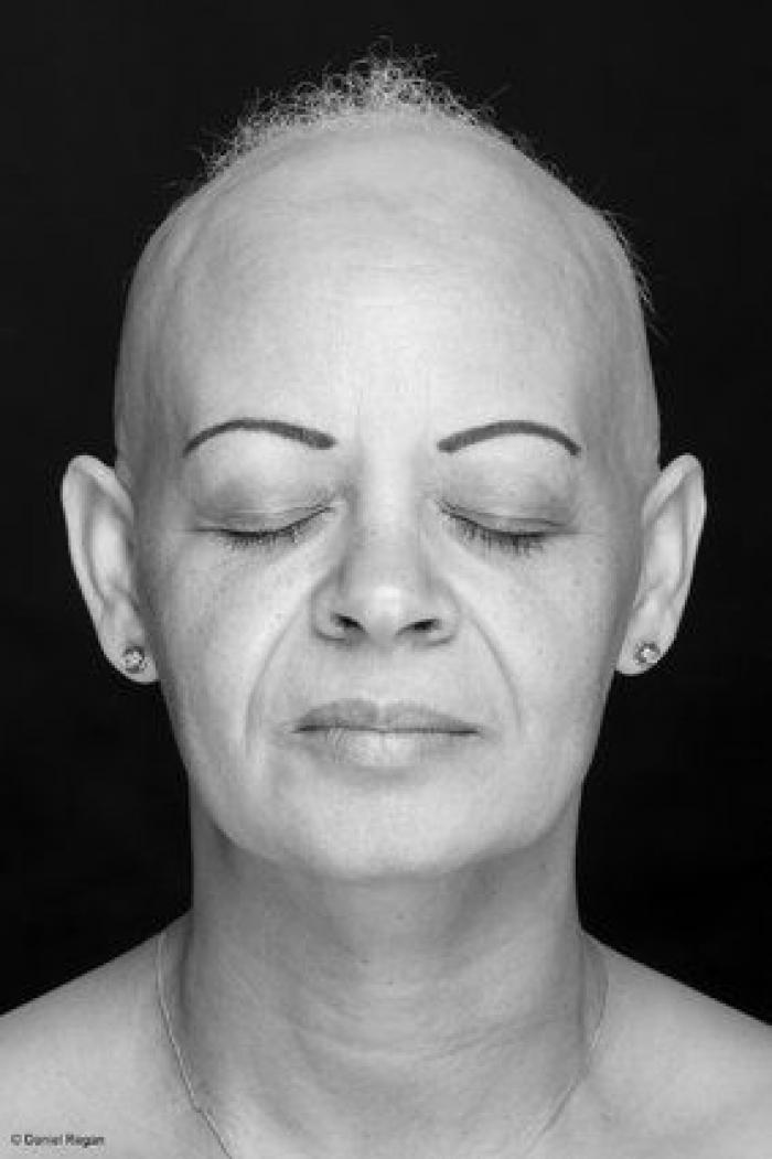 Una joven con alopecia celebra su calvicie con una sesión de fotos