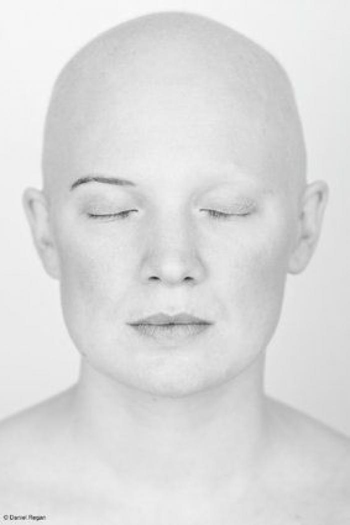 Impactantes fotos de personas con alopecia demuestran que la calvicie es hermosa