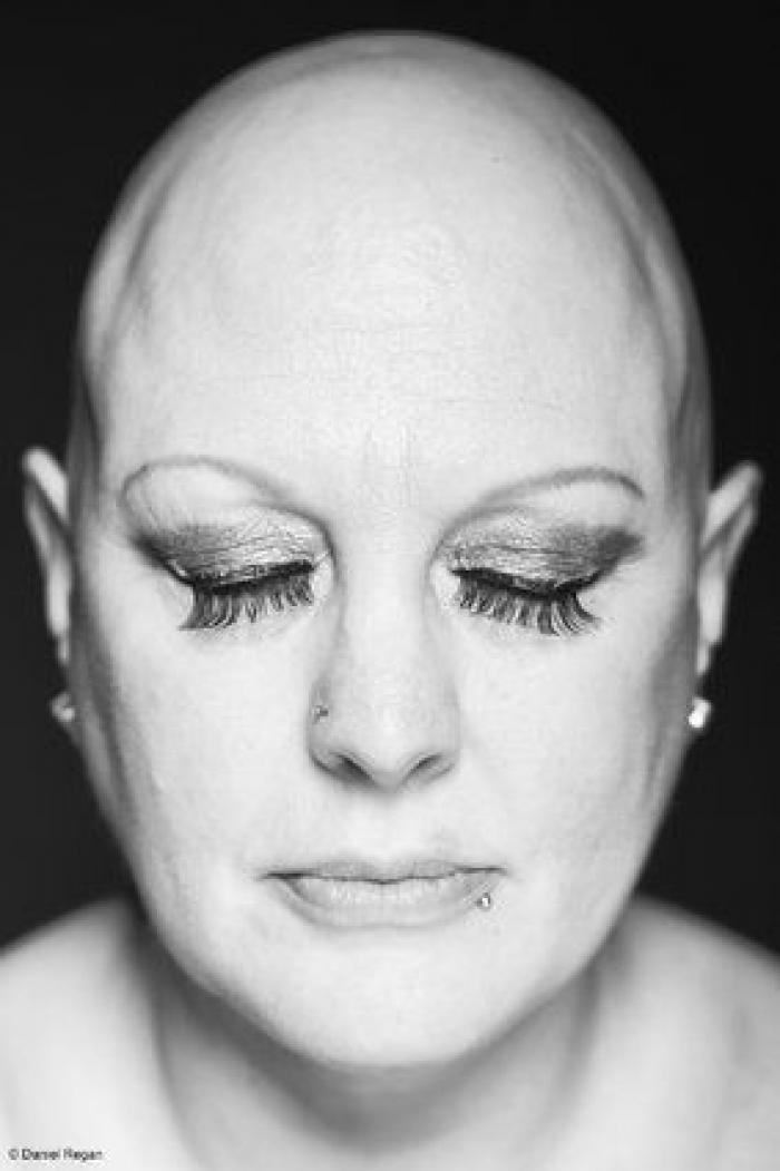 Una joven con alopecia celebra su calvicie con una sesión de fotos