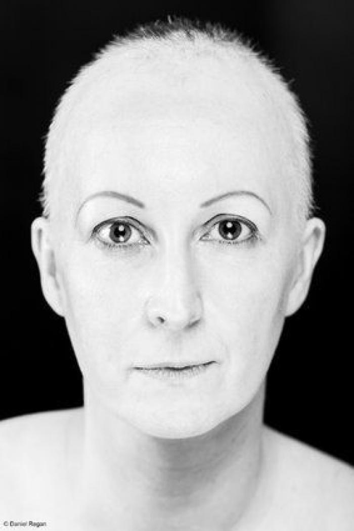 Impactantes fotos de personas con alopecia demuestran que la calvicie es hermosa