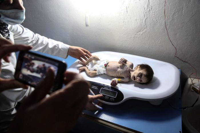 La muerte ronda a los niños malnutridos de los asediados suburbios de Damasco