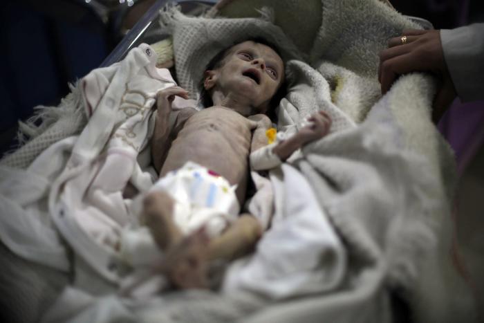 La muerte ronda a los niños malnutridos de los asediados suburbios de Damasco