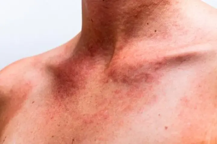 noticiaspuertosantacruz.com.ar - Imagen extraida de: https://www.huffingtonpost.es//sociedad/sarpullido-calor-que-mas-sensible-dermatitis-como-tratar-picor-hpe1.html