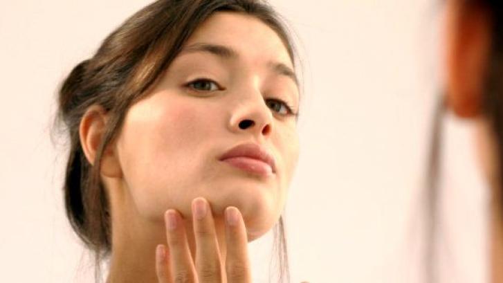 10 preguntas frecuentes y 10 respuestas sobre el acné adulto