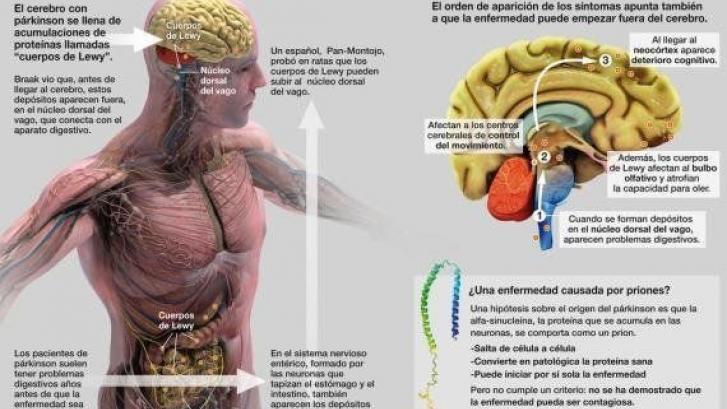 Investigadores estadounidenses descubren que el Párkinson puede originarse en el intestino