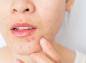 Esta es la causa de tu acné, según la zona de la cara donde aparece