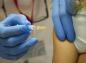 Un estudio confirma la eficacia de la vacuna contra el meningococo B utilizada en España