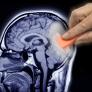 Investigadores alzan la voz por la prueba por imágenes que podría aumentar las probabilidades de desarrollar cáncer