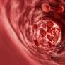 Los investigadores ven algo común en personas que han sufrido síntomas de accidente cerebrovascular y apuntan a un gran problema mundial