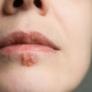 Un estudio asocia el herpes labial a más propensión a desarrollar alzhéimer