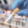 Salud investiga un posible brote de hepatitis A en Jumilla (Murcia)