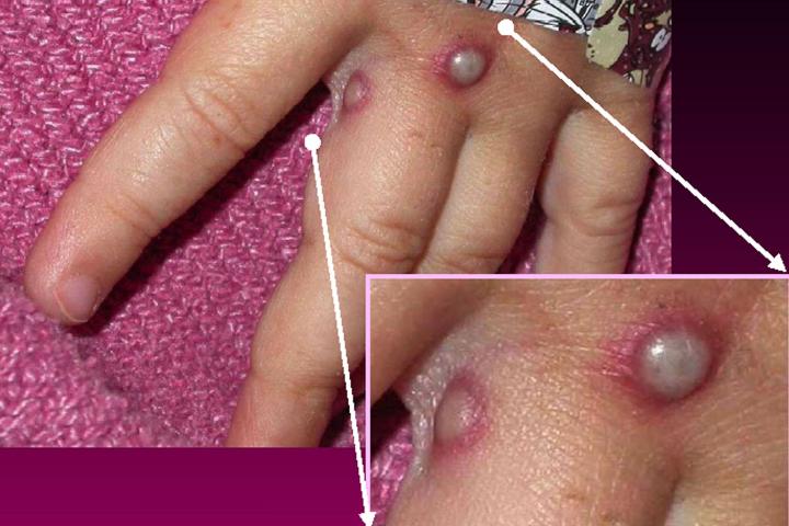 Lesiones de la viruela de mono en la piel.