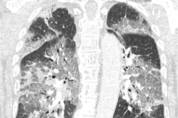 Imagen de los pulmones contagiados con coronavirus del hombre que rechazó la vacuna de AstraZeneca.