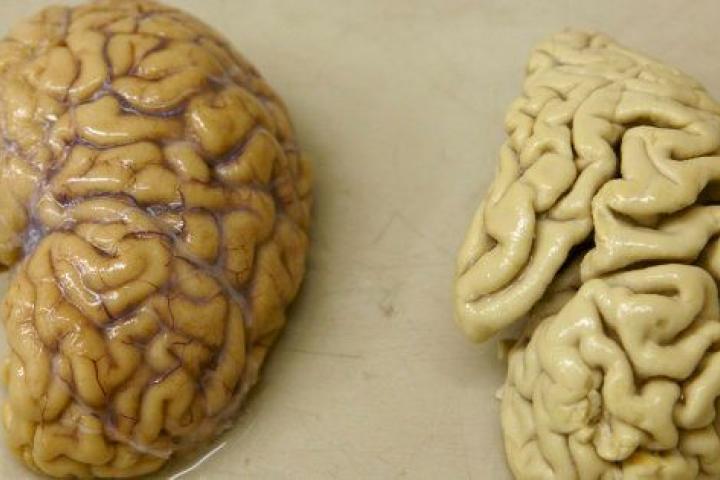 Un hemisferio de un cerebro sano (izquierda) junto a uno de un paciente con alzheimer.