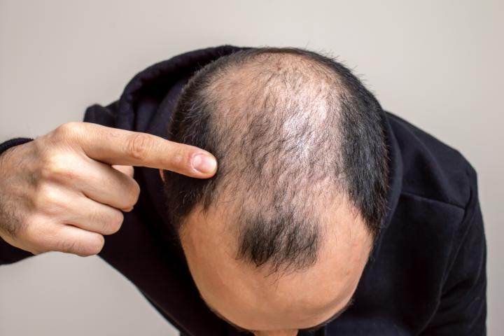 Detectar los primeros síntomas de alopecia es fundamental para atajarla.