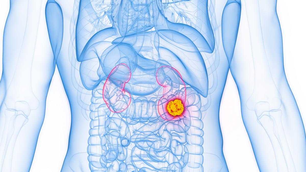 Intriga entre los médicos por la rara dolencia asociada al cáncer de riñón