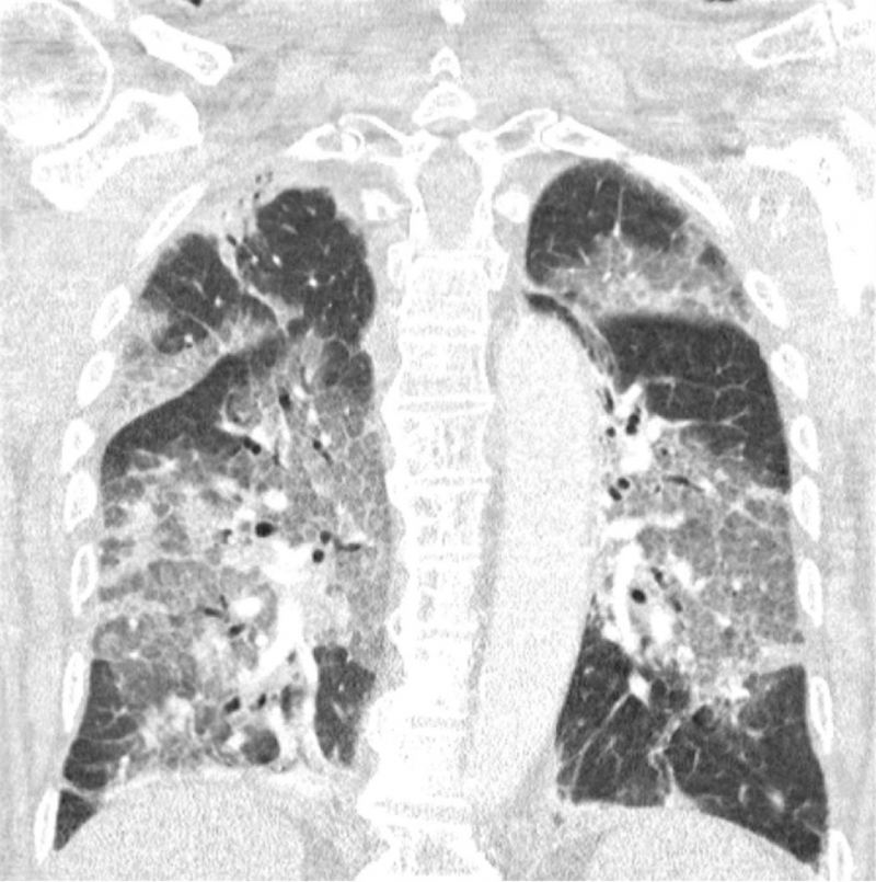Imagen de los pulmones contagiados con coronavirus del hombre que rechazó la vacuna de AstraZeneca.